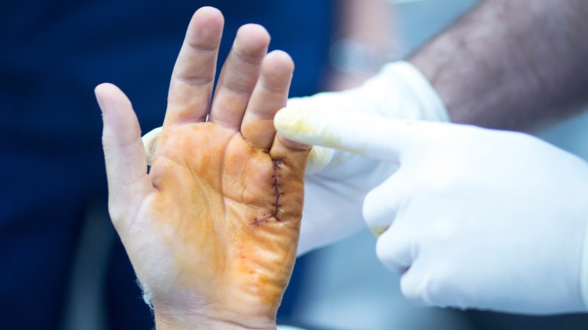 Fasciectomy surgery for dupuytren's contracture
