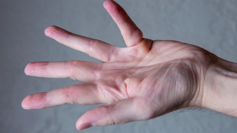Palma mano con contractura