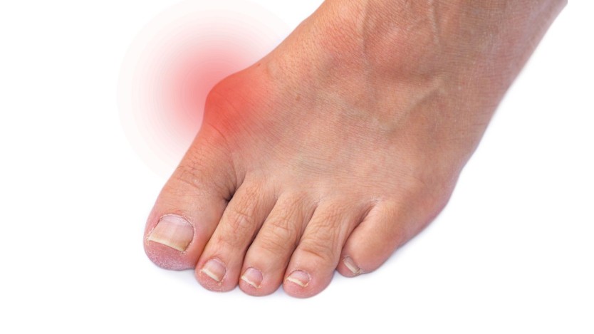 Hallux-valgus-Operation