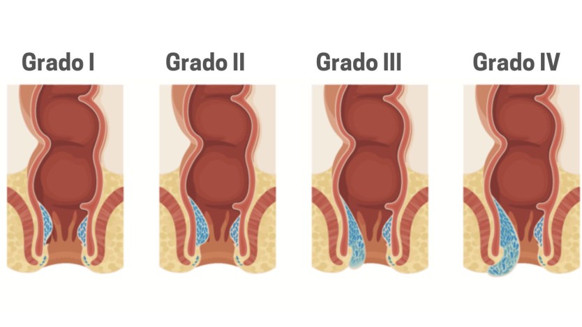 Grade der Hämorrhoiden