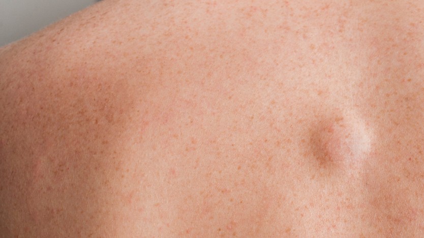 Lipomas and Sebaceous Cysts Removal