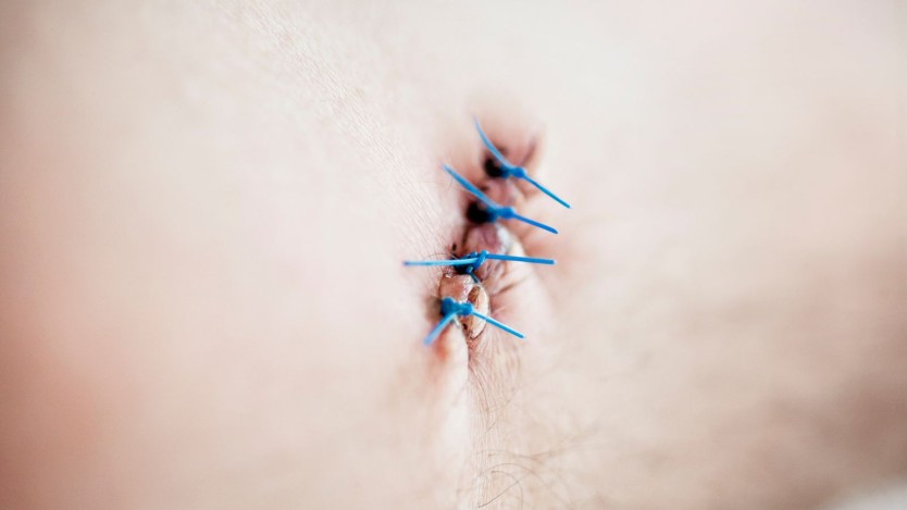 Lipoma and Sebaceous Cyst Removal